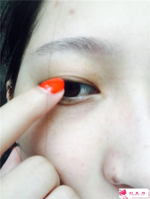 做雙眼皮手術(shù)的費用是和哪些因素有關(guān)