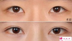 做雙眼皮的價(jià)格是與什么有關(guān)系