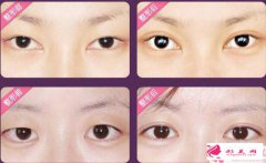 雙眼皮穩(wěn)定成效怎么樣？