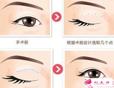 如何選擇開內(nèi)外眼角_開內(nèi)眼角好還是開外眼角？