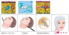 面部吸脂能減多少脂肪