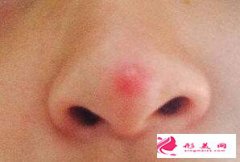 鼻子上長(zhǎng)痘可以做假體隆鼻手術(shù)嗎