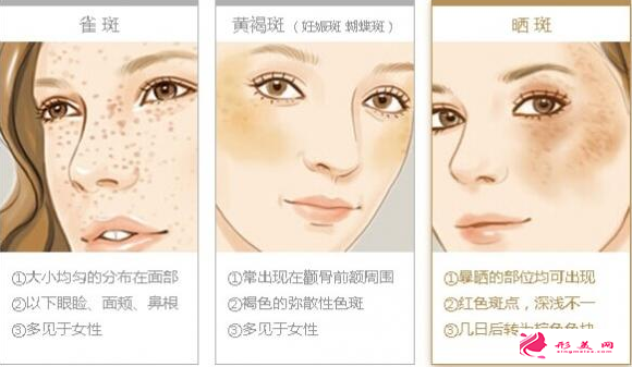 做激光祛斑大概要花多少錢(qián)