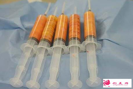 自體脂肪豐胸有哪些缺陷