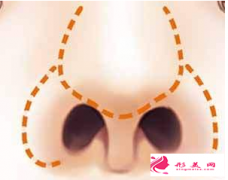 鼻翼縮小手術(shù)常見(jiàn)風(fēng)險(xiǎn)有哪些？