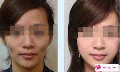 自體脂肪填充臉頰怎么樣
