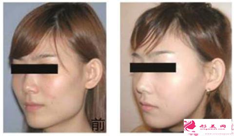 顴骨整形的恢復時間_顴骨整形恢復時間要多久呢