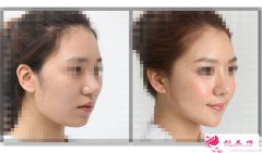 顴骨整形恢復(fù)時間要多久呢？