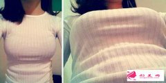 自體脂肪隆胸效果受什么因素影響