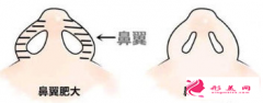 鼻翼縮小手術(shù)的疤痕怎么處理