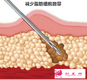吸脂減肥手術(shù)貴不貴