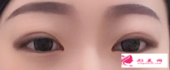 在廣州割雙眼皮要多少錢？