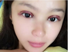 成都劉輔容雙眼皮修復(fù)到底怎么樣？和大家分享一波劉輔容眼修復(fù)案