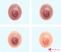 乳暈縮小手術(shù)后會(huì)留疤嗎？