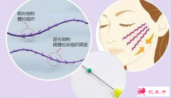 臉部做了線雕多久沒(méi)有緊繃感