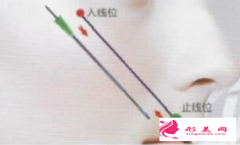 埋線提升后臉部有凹陷怎么回事