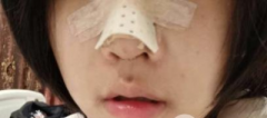 硅膠隆鼻案例|從18歲就想換鼻子，做完竟然有點(diǎn)韓系~
