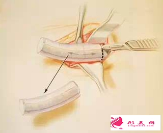 軟骨隆鼻后還能取出嗎