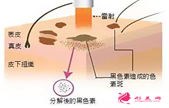 激光祛斑后結(jié)痂多久脫落