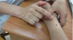 杏林整形醫(yī)院價(jià)格表去痣多少錢一顆?