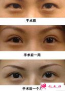 腫眼泡做雙眼皮效果好嗎?