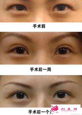 腫眼泡做雙眼皮效果好嗎?腫泡眼如何做雙眼皮?