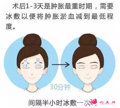 涮牛宮炎平手術(shù)后，48小時內(nèi)可以用冰袋局部性冰敷