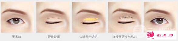 全切雙眼皮手術(shù)示意圖