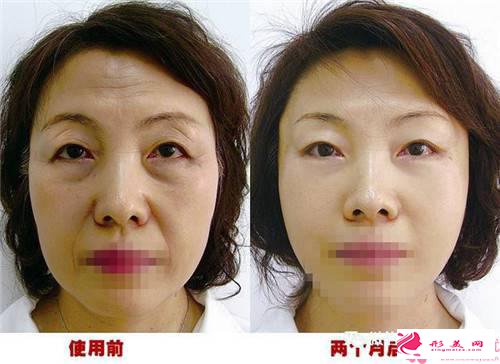怎樣可以消除下眼袋_下眼袋怎么才能去掉