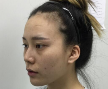 全臉脂肪填充消腫后效果很好真實(shí)案例