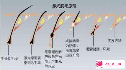 激光脫毛有色素沉著怎么辦