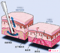 大腿吸脂后對正常運(yùn)動有影響嗎