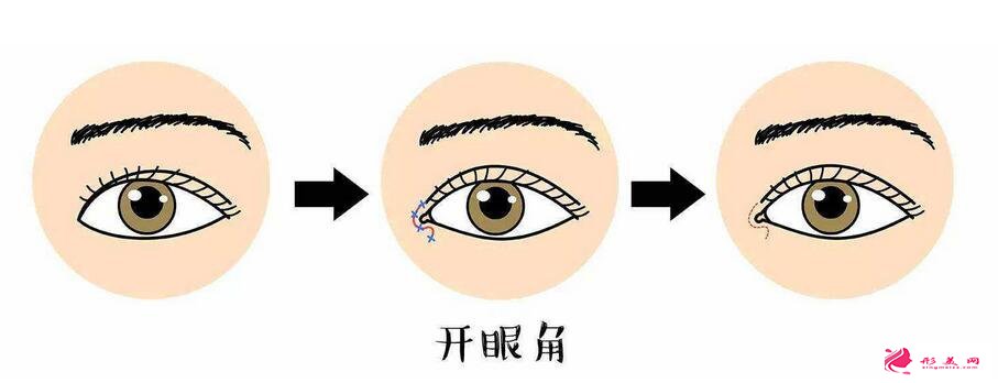 適合開眼角