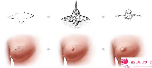 乳暈再造手術(shù)以后要注意的事情_乳暈再造術(shù)后的護理