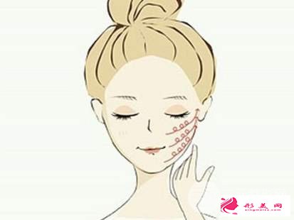 治療下頜角肥胖方法