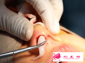 隆鼻手術失敗后幾天可以取出假體