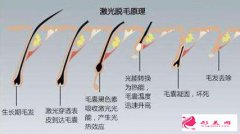 激光脫毛后為什么還會(huì)再長(zhǎng)？