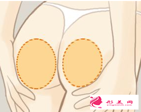 廣州做臀部吸脂要多少錢