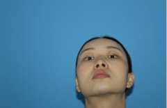 廣州韓妃整形醫(yī)院的真人案例有木有？