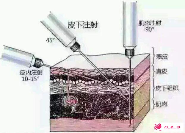 玻尿酸填充的風險