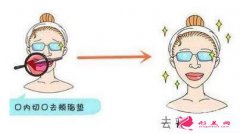 去頰脂墊價(jià)格多少錢？