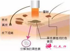懷孕可以做激光祛黃褐斑嗎？