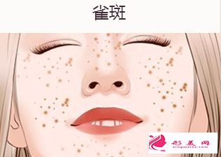 激光祛雀斑一次能做好嗎