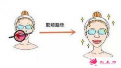 去頰脂墊效果多久出來？需要注意什么？