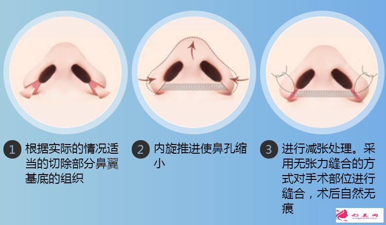 鼻翼縮小手術(shù)后多久才可以化妝