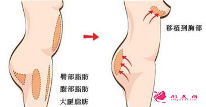 自體脂肪隆胸后多久才能哺乳