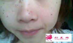 激光祛雀斑每次治療要間隔多久