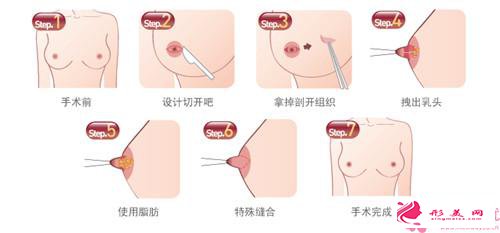  乳頭內(nèi)陷的花費(fèi)_乳頭內(nèi)陷矯正手術(shù)需要多少錢