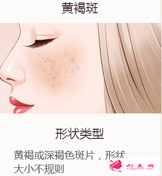 激光祛黃褐斑多久可以做第二次