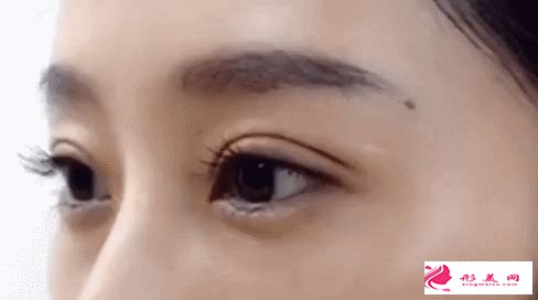 割雙眼皮需要多少錢